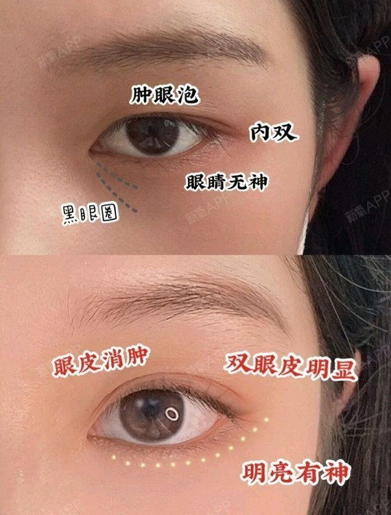 妹子我是内双 肿泡眼,眼距是可以的,偶然得知同学割_圈子-新氧美容