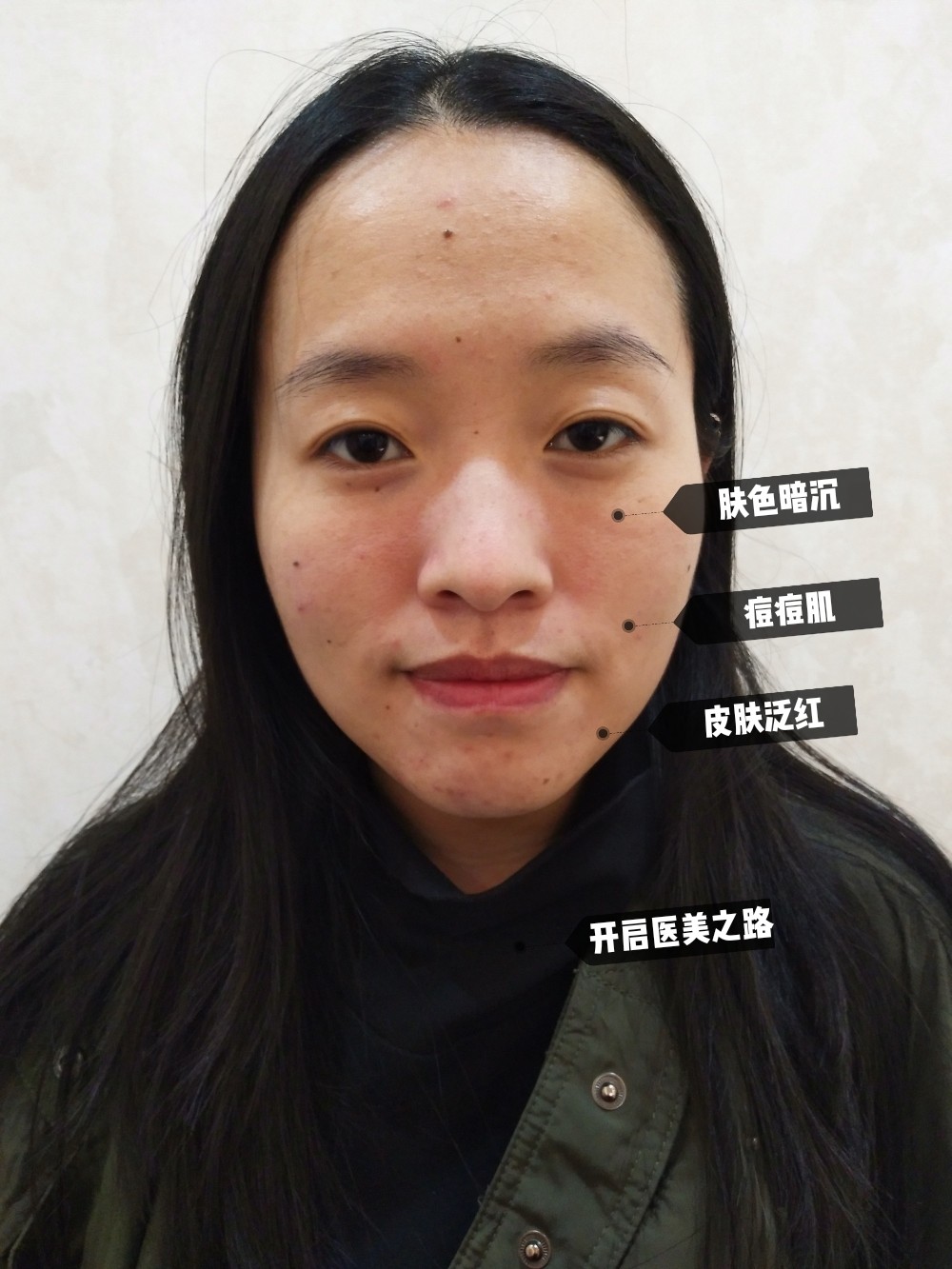 光子嫩肤多久做一次