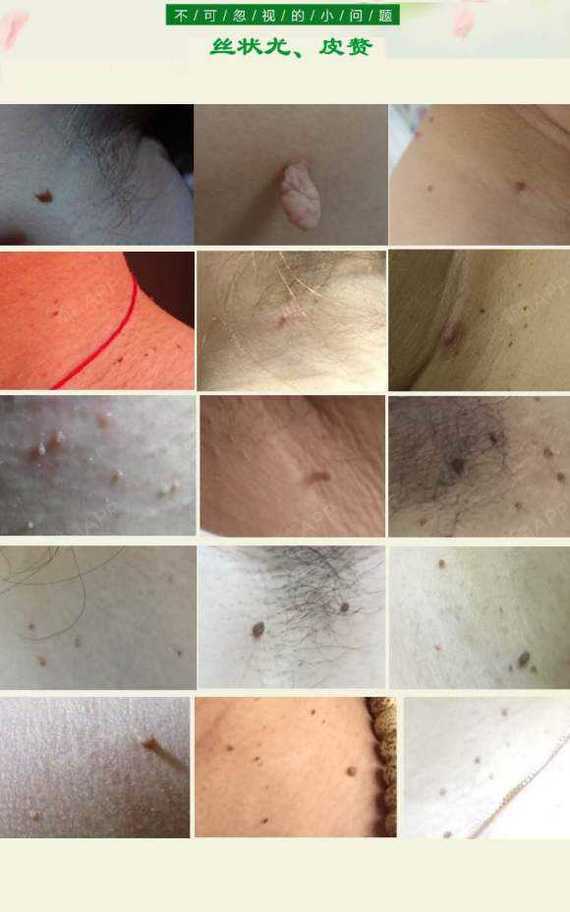 早期症状人类乳头瘤病毒乳头状疣赘生物小息肉假性疣高清图片