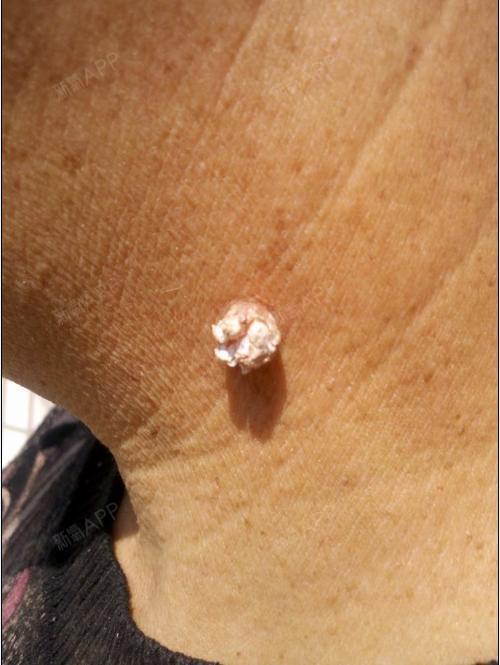 病毒是什么人乳头瘤乳头瘤图片 早期症状小息肉状假性疣图片皮肤赘