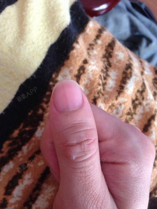 生乳头疣手指赘生物图片手指赘生物乳房上的疣体手指息肉手指长乳头瘤