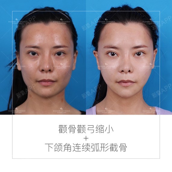 所以在通过手术解决下颌角问题时,医生都会建议切除咬肌同时进行,以