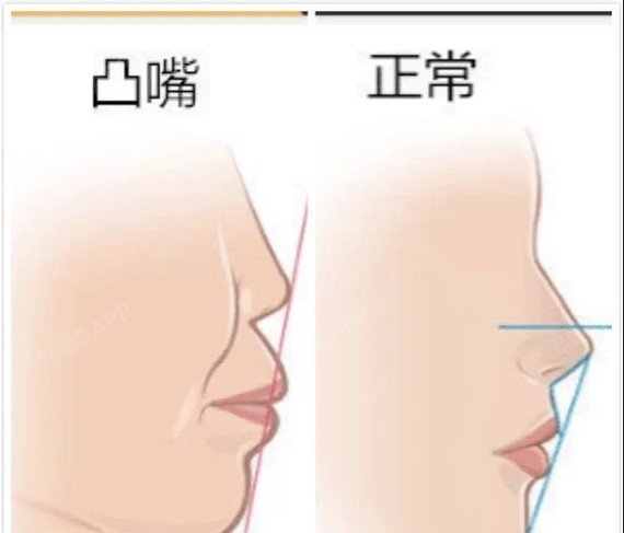 小心!翘翘的嘟嘟嘴,可能是嘴凸哦 嘴凸分为骨性和牙性