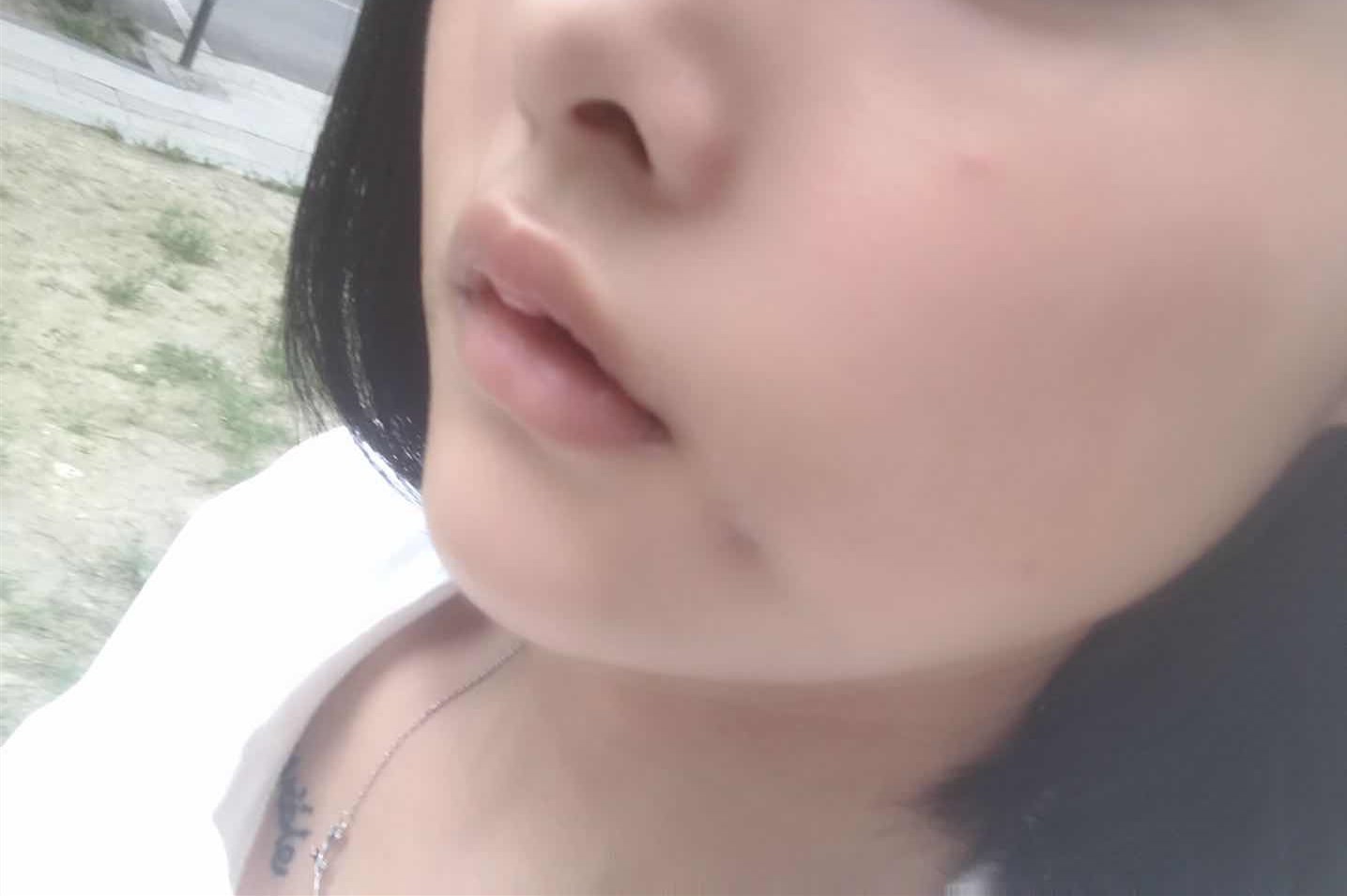 【成都渼淳玉颜】做完上唇m唇和手术梨涡,今天是第十_圈子-新氧美容