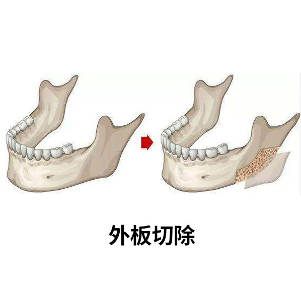 我们的下颌角是由内板,骨髓腔和外板三个结构构成的,很像一个三明治