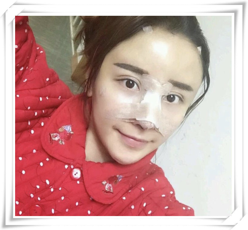 隆鼻效果的维持时间也是不同 线雕隆鼻做线雕鼻子需要依靠蛋白线拉升