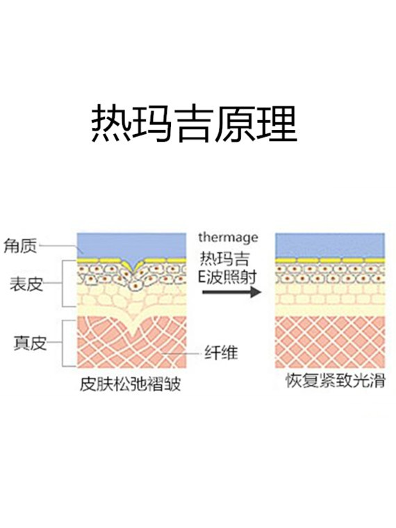 起码你要弄懂热玛吉的原理,功效,仪器等等