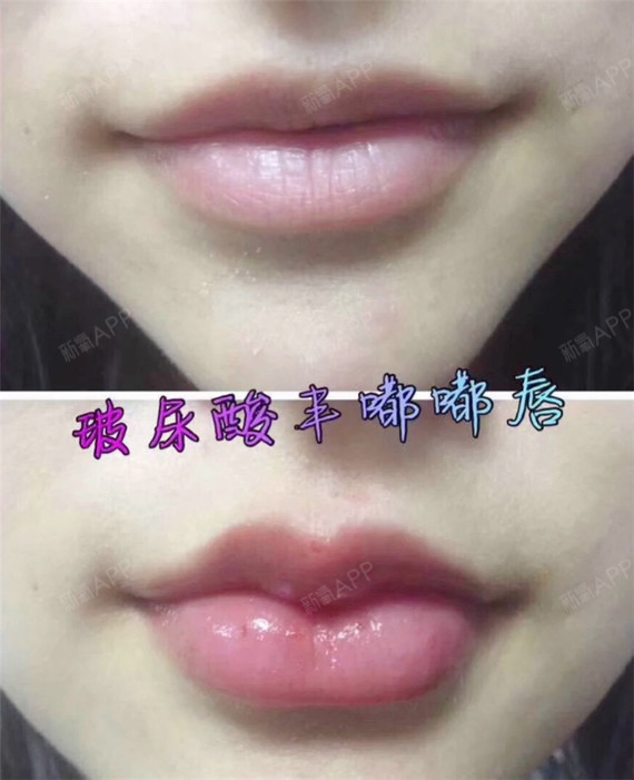 微笑唇和嘟嘟唇到底有什么区别?