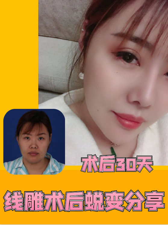 线雕术后蜕变分享 术后30天