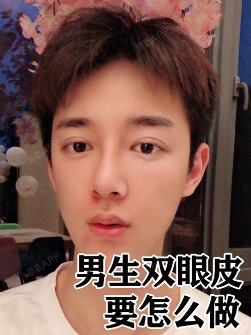 男生做双眼皮的改变有多大