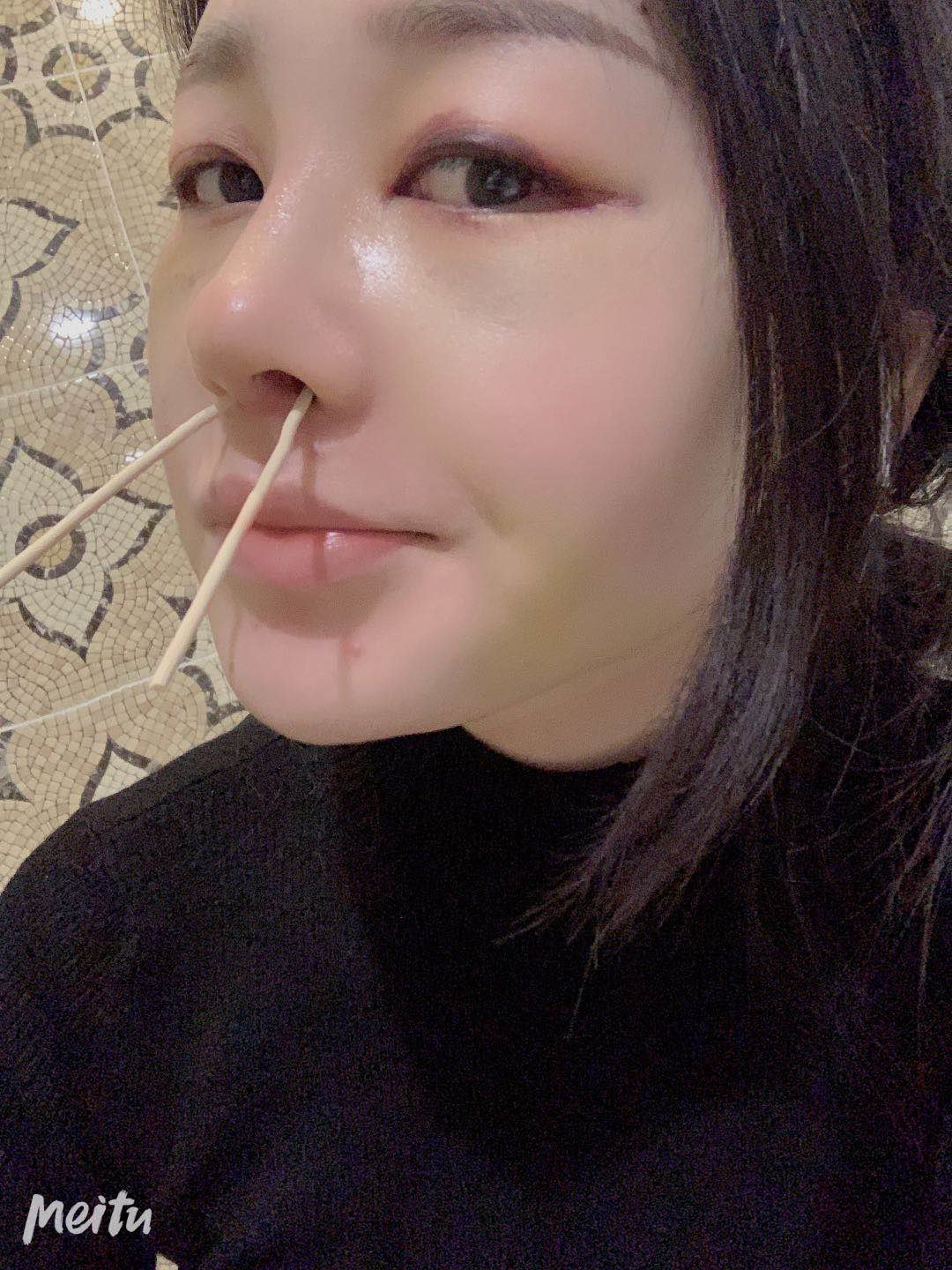 半肋仿生鼻术后8天
