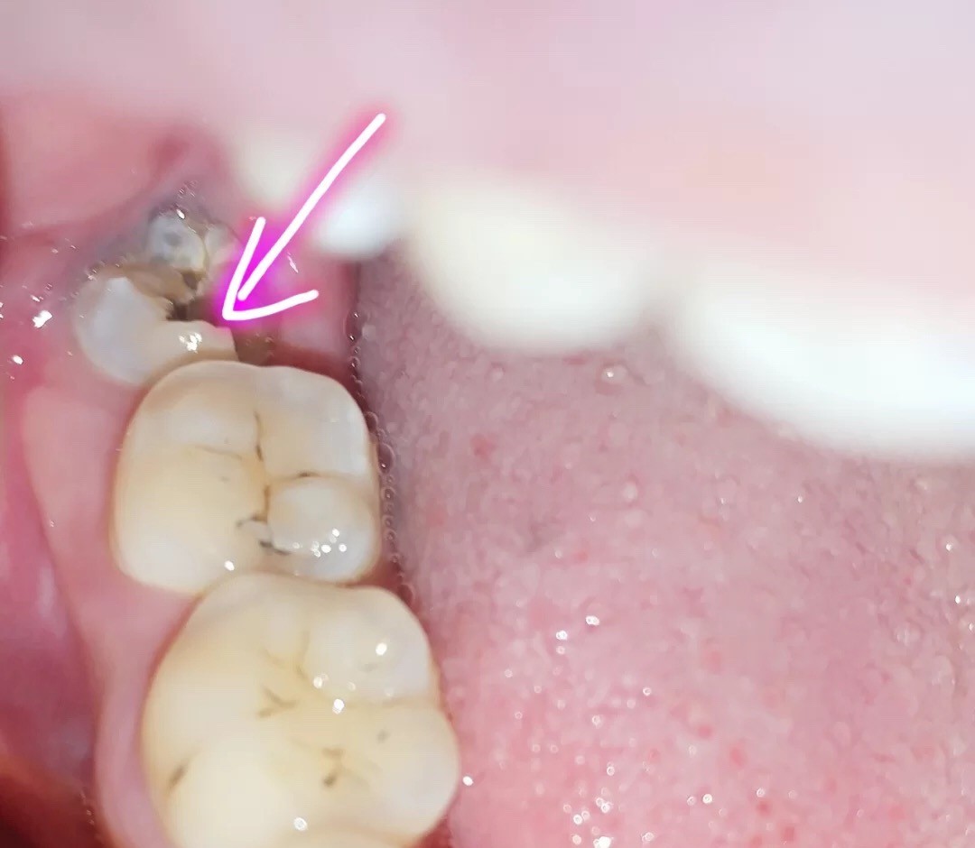 蛀牙初期 症状:牙齿上有小黑线和小黑点,牙斑 做法:初期是预防的zui