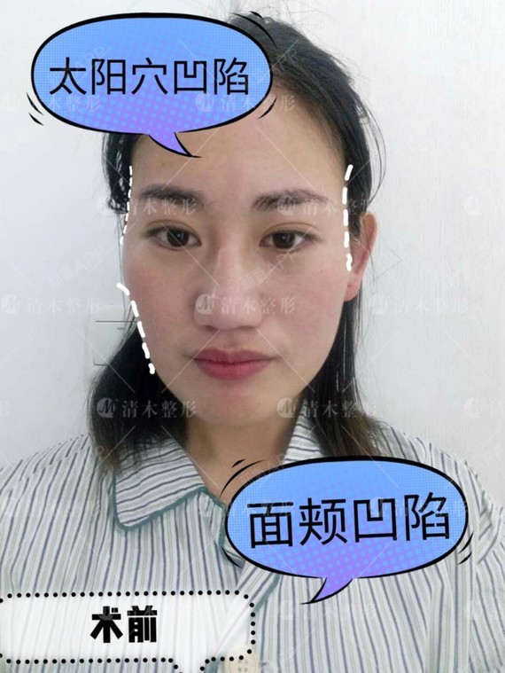 面部凹陷易显老,该怎么办?"微琢活脂术"拯救你!