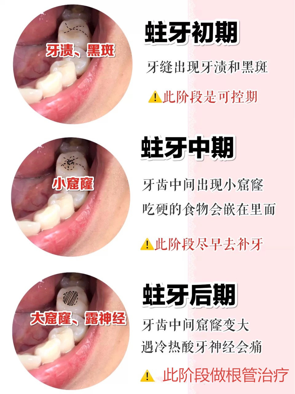 别慌长蛀牙不可怕做到这些可预防