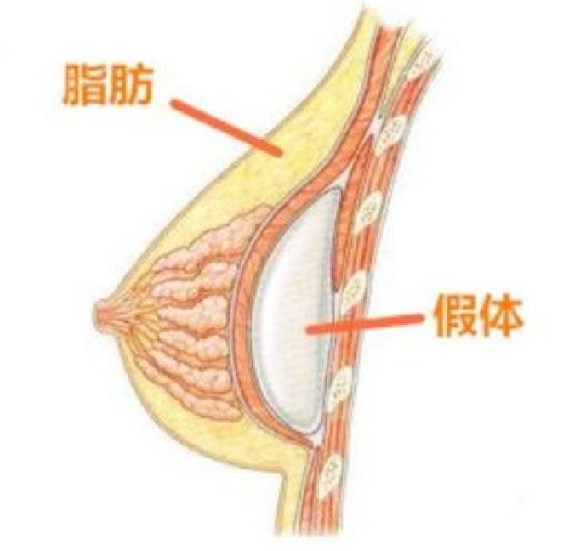 隆胸后男票会不会一摸就摸出来