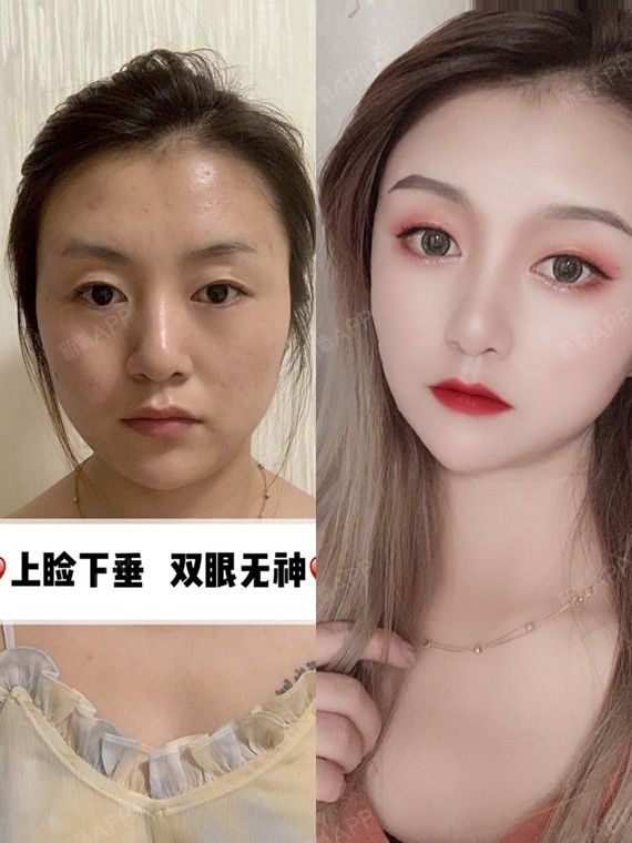 骆显红真人案例美商课堂 :再见,我的小眼睛!