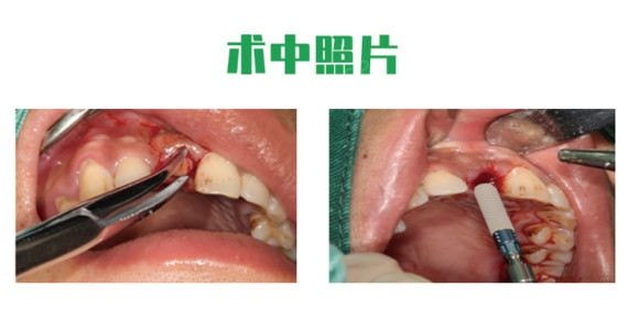 种植过程中,熊院长沿着种植导板将种植体植入牙槽骨中,以确保