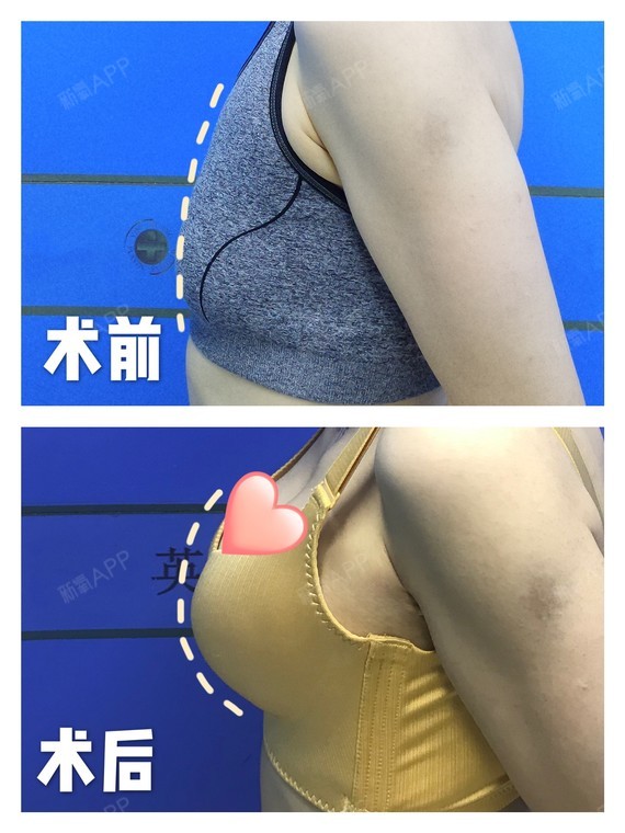 产后干瘪胸部大改造