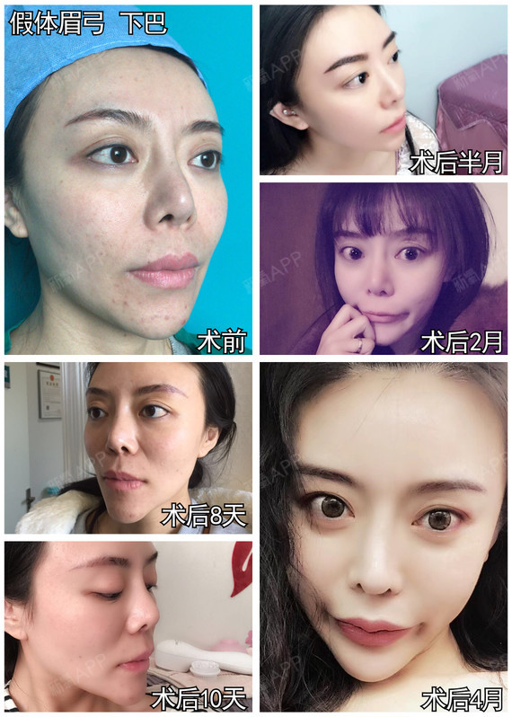 对于假体眉弓大多数人关心的两个问题