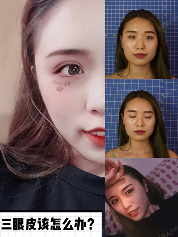 三眼皮该怎么办?