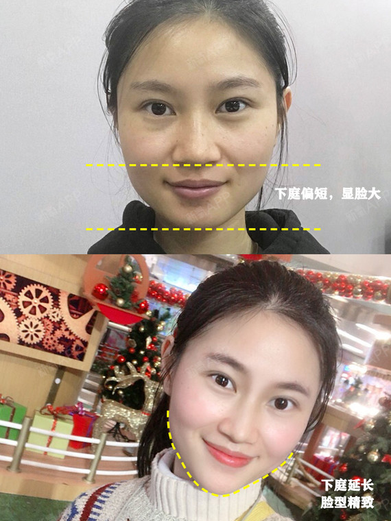 广州曙光玻尿酸瘦脸针一周拥有完美下颌线