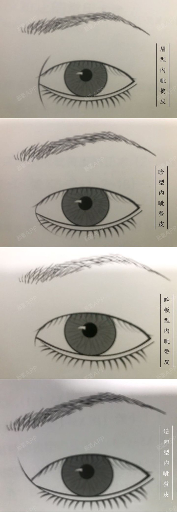 在睁眼时可以遮盖内眦泪阜的一部分或全部,是亚洲人眼睛的特征之一