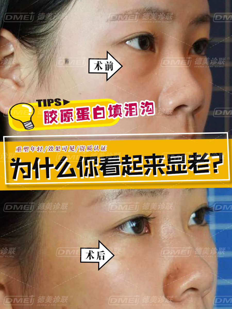 胶原培植填充泪沟维持多久(胶原培植填充泪沟维持多久恢复)