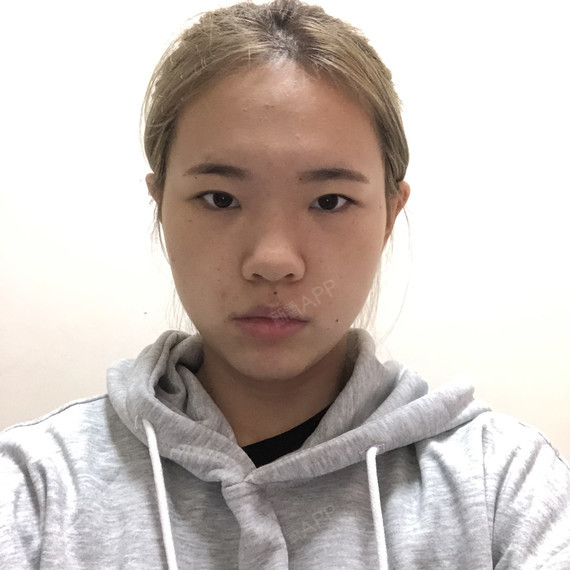 宝宝本身轻微肿眼泡,黑眼球暴露率不够,眉眼间距宽