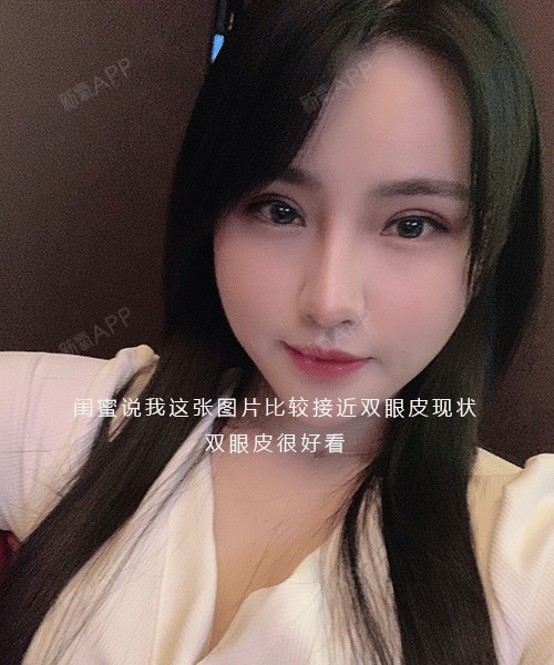 求美者分享:7mm全切双眼皮术后15天,恢复自然