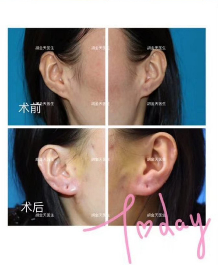 玻尿酸注射耳垂手术案例