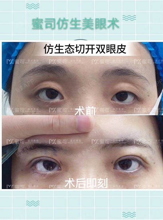 眼窝凹陷用什么填充?做完上眼窝脂肪填充后眼睛睁不大了是怎么回事?