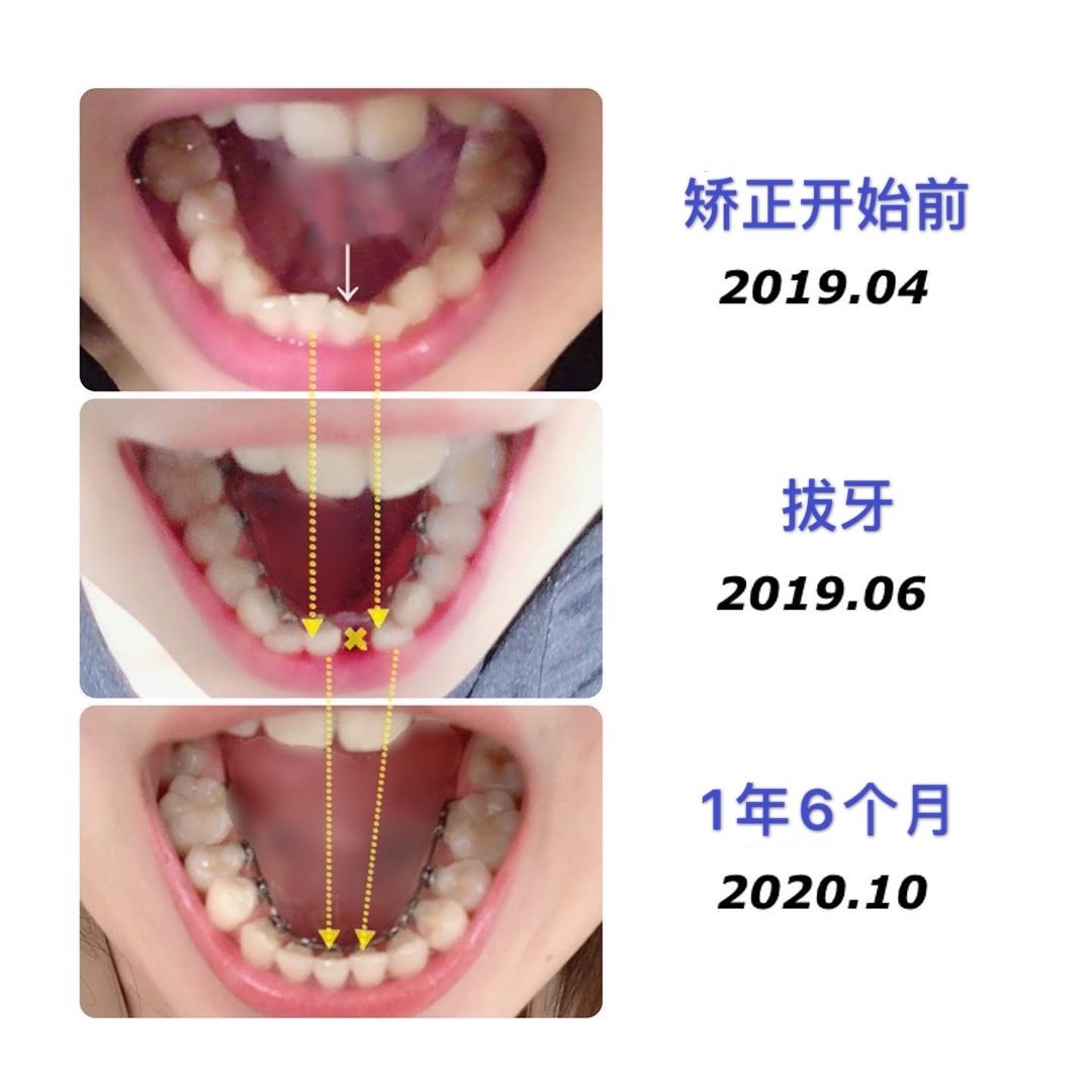 牙齿矫正案例 一年零6个月 正畸侧颜变化记录