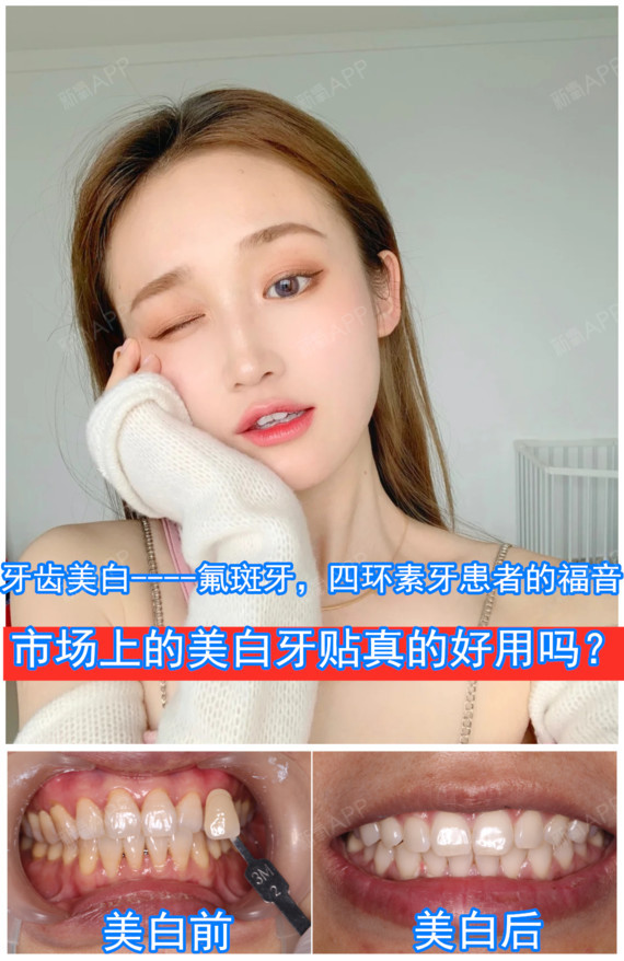 牙齿美白----氟斑牙,四环素牙患者的福音