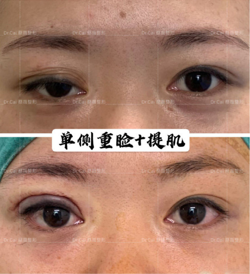 今天分享一个单侧双眼皮手术.患者