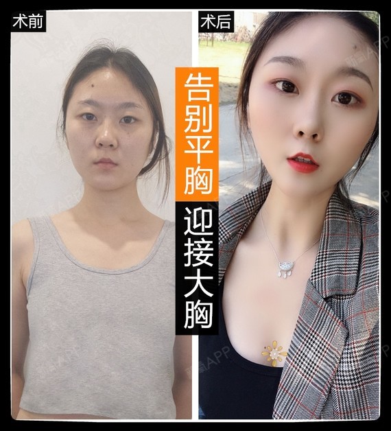 【南京美贝尔-傲诺拉隆胸】
