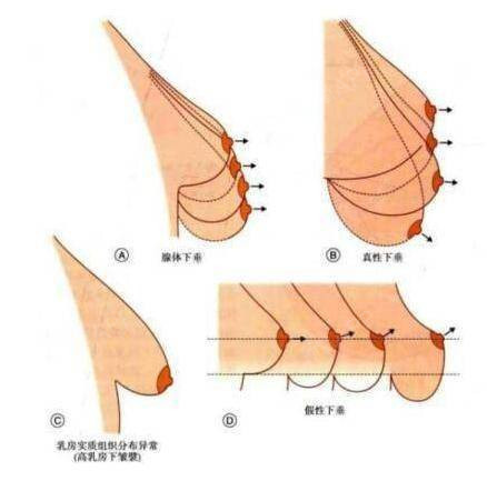 乳房上提轻松拯救!