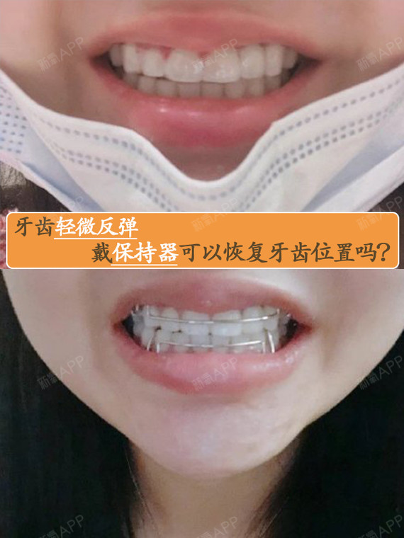 牙齿轻微反弹,戴保持器可以恢复牙齿位置吗?