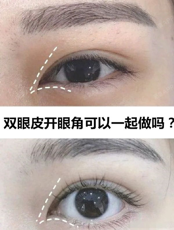 双眼皮开眼角手术可以一起做吗?