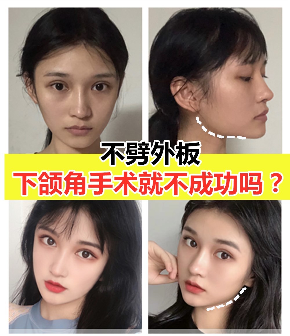 《不劈外板,下颌角手术就不成功吗?》