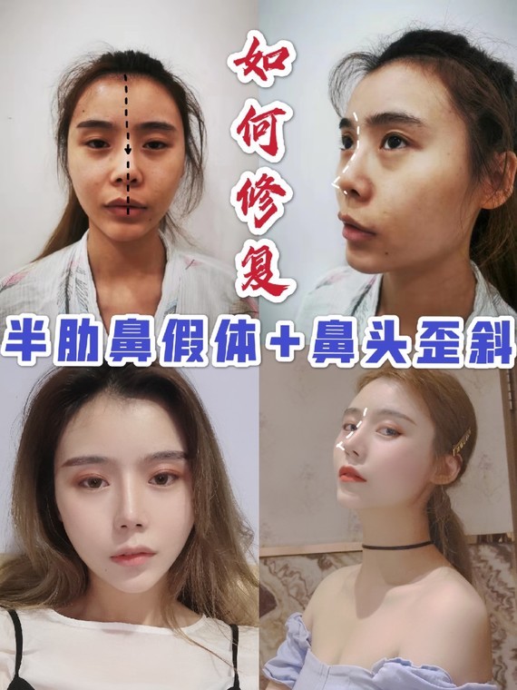 案例分析|半肋鼻术后假体和鼻头肋软骨都歪了