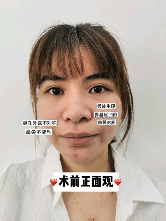 案例分享|鼻孔外露不对称鼻修复