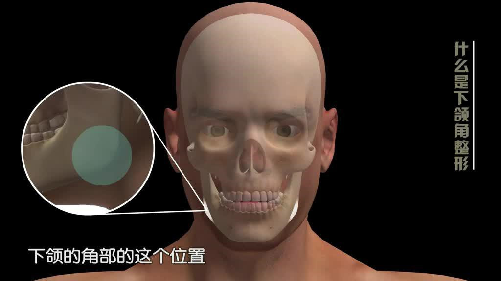 宽的下颌角整形有没有标准?如何判断下颌骨宽呢?