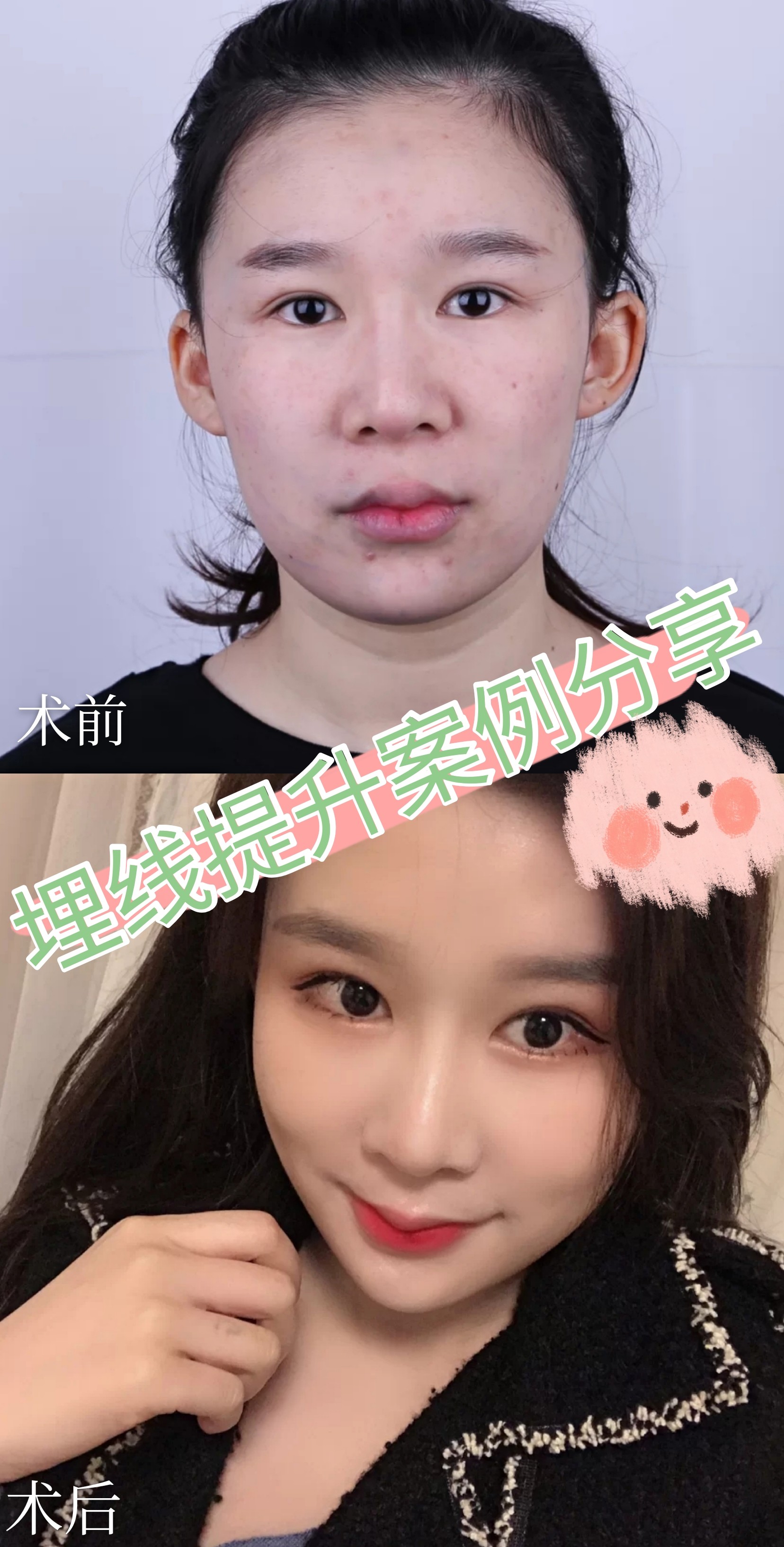 93很多女性都认为埋线提_圈子-新氧美容整形