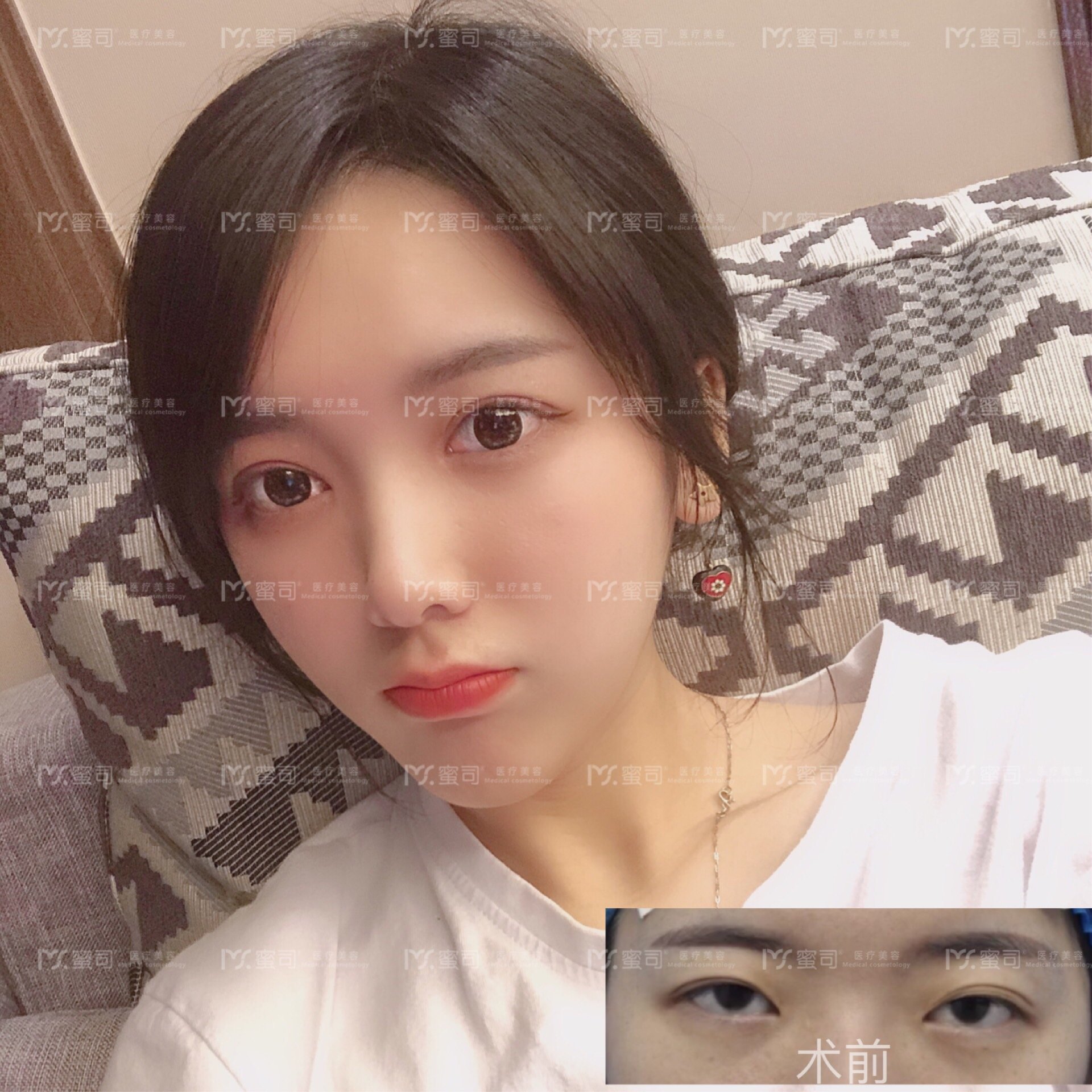 开眼角有什么风险吗?术后如何护理呢?