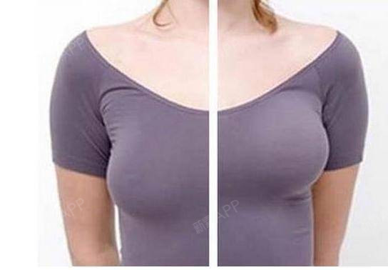 通过正确的乳房下垂矫正方法才能达到理想胸型