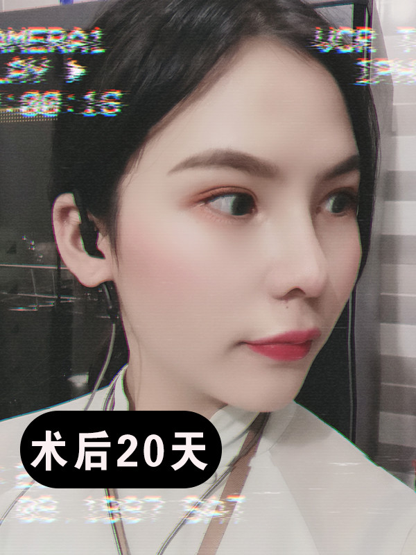 超肋隆鼻案例分享