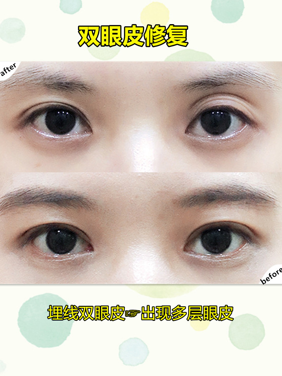 手术方案:菡式微切重睑修复术 术后反馈:多层眼皮问题得到解决,眼皮