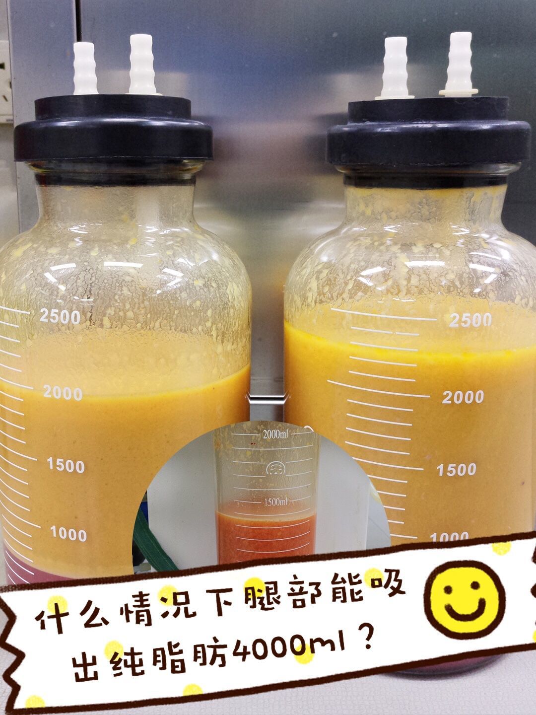 什么样的腿部可以抽出纯脂肪4000ml?