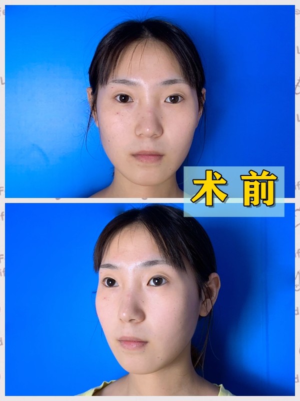 如何判断自己"眼距"是否过宽