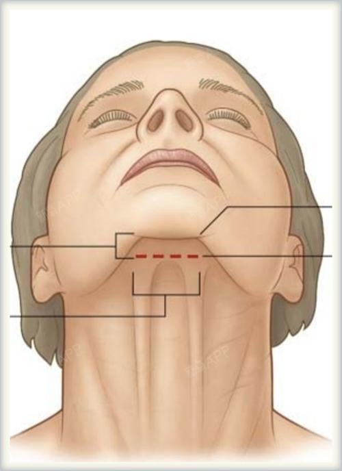 下颌缘指的是:下颌骨与下颌之间的那一段弧线骨组织